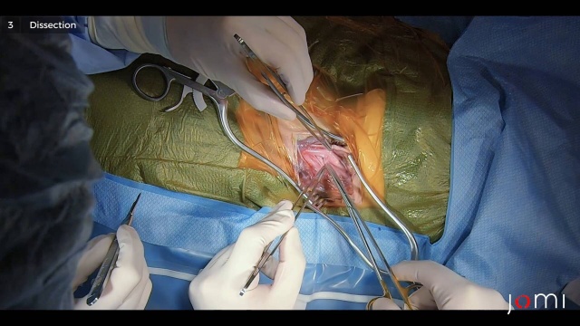 endarterectomy
