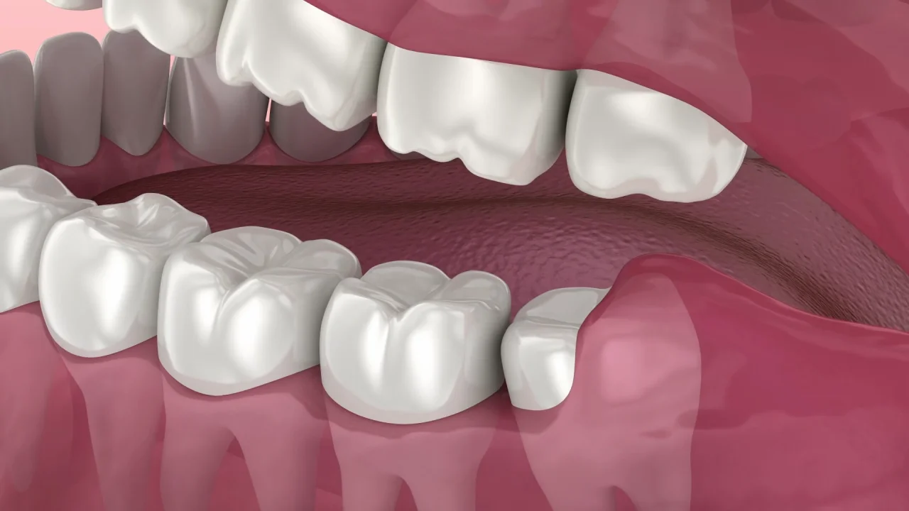 wisdom tooth eruption