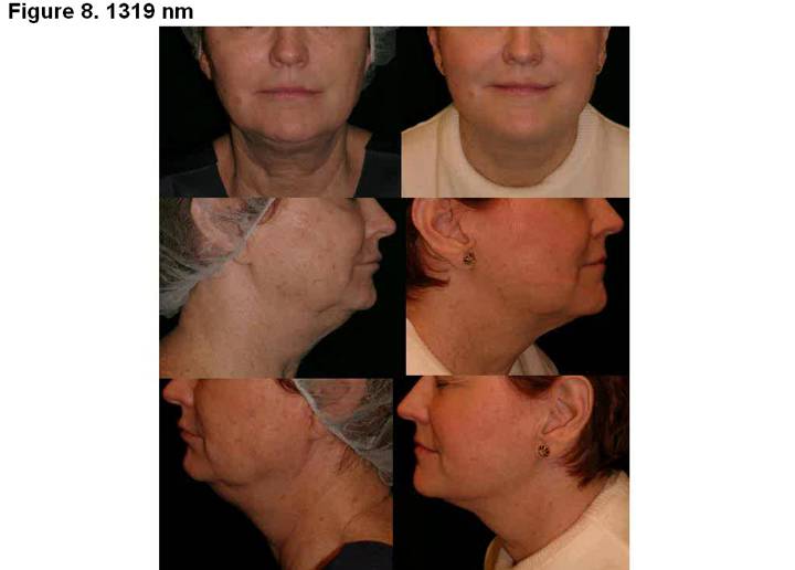 Thumbnail for Results of Improved Submentum and Skin Laxity with the Sciton Laser Technology