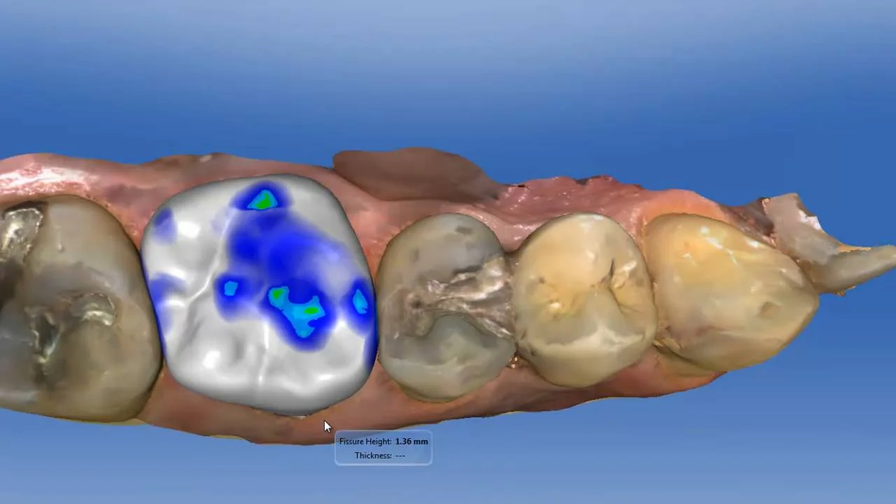 CDOCS Free Video - Occlusal Offset