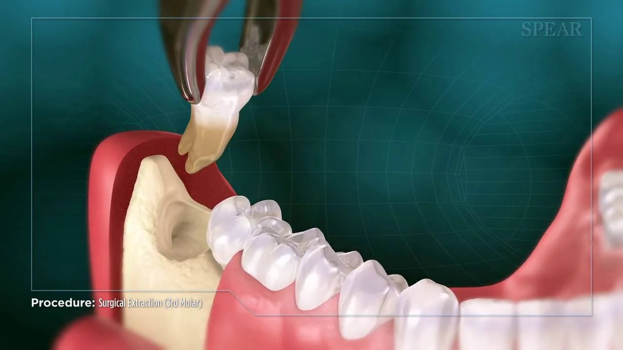 Tooth extraction. Удалённый зуб мудрости. Удаленные зубы мудрости.