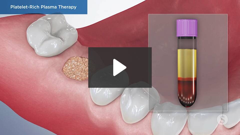 Prr Tooth Platelet-rich plasma (PRP) therapy - Premier Dental Associates