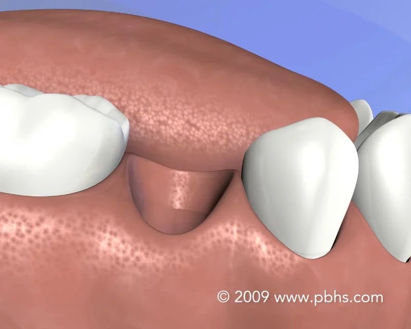Tooth Extractions » Springfield MA Oral Surgery » McNally Brothers