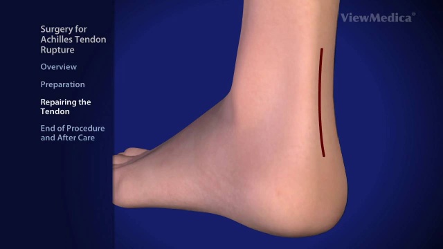 surgery for achilles tendon rupture podiatrist arizona