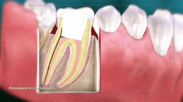 Root Canal Re Treatment Why Re Treat A Root Canal