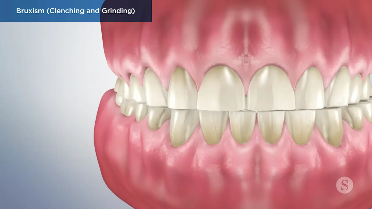 Le grincement des dents : le bruxisme - Dentalespace