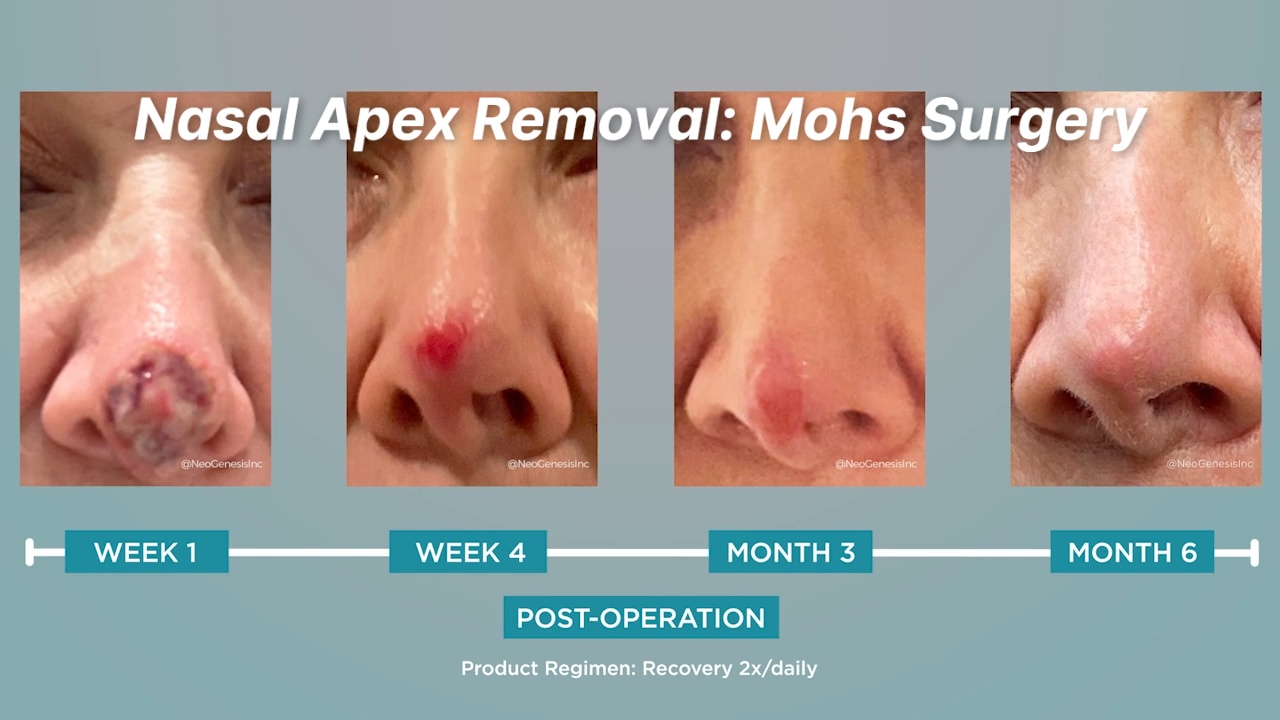 Mohs Surgery Daily Wound Care - Nose Incision