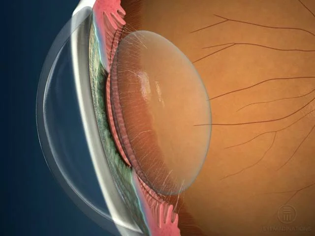 intraocular lens types