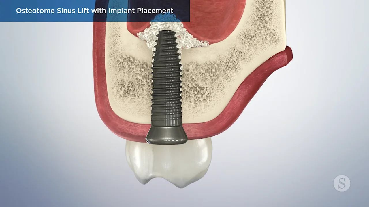 The Sinus Bone Graft ザサイナスボーングラフト-