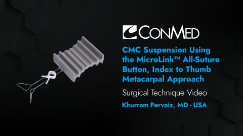 Dr. Shuler - CMC Suspension Using the MicroLink™ All-Suture Button, Index to Thumb Metacarpal Approach