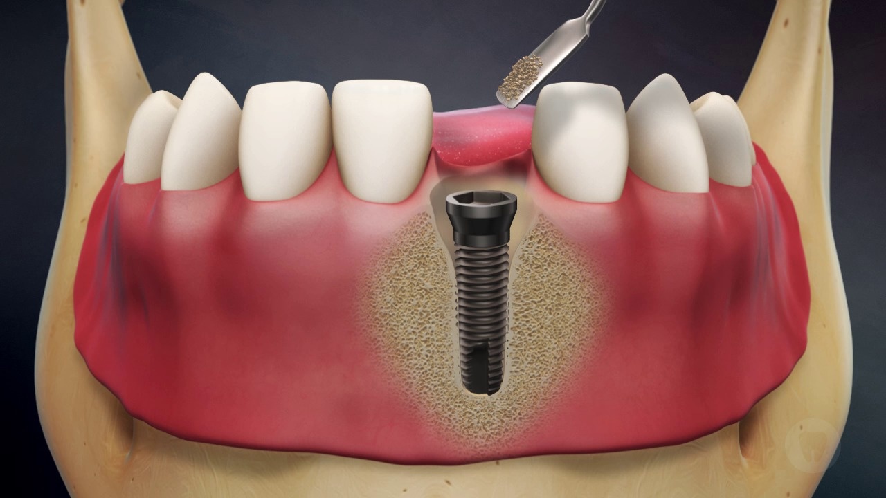 Tooth Loss: Socket Preservation with Implant and G