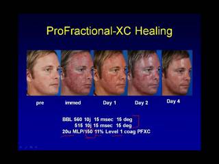 Thumbnail for The Clinical Benefits of Coagulation with Fractional Ablation Using Sciton’s ProFractional™ XC