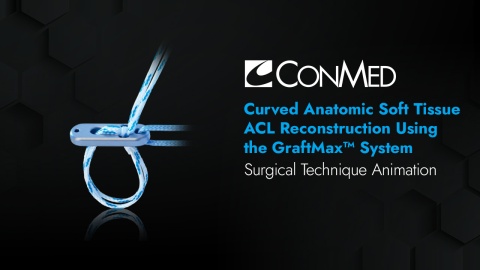 Curved Anatomic Soft Tissue ACL Reconstruction Using the GraftMax™ System