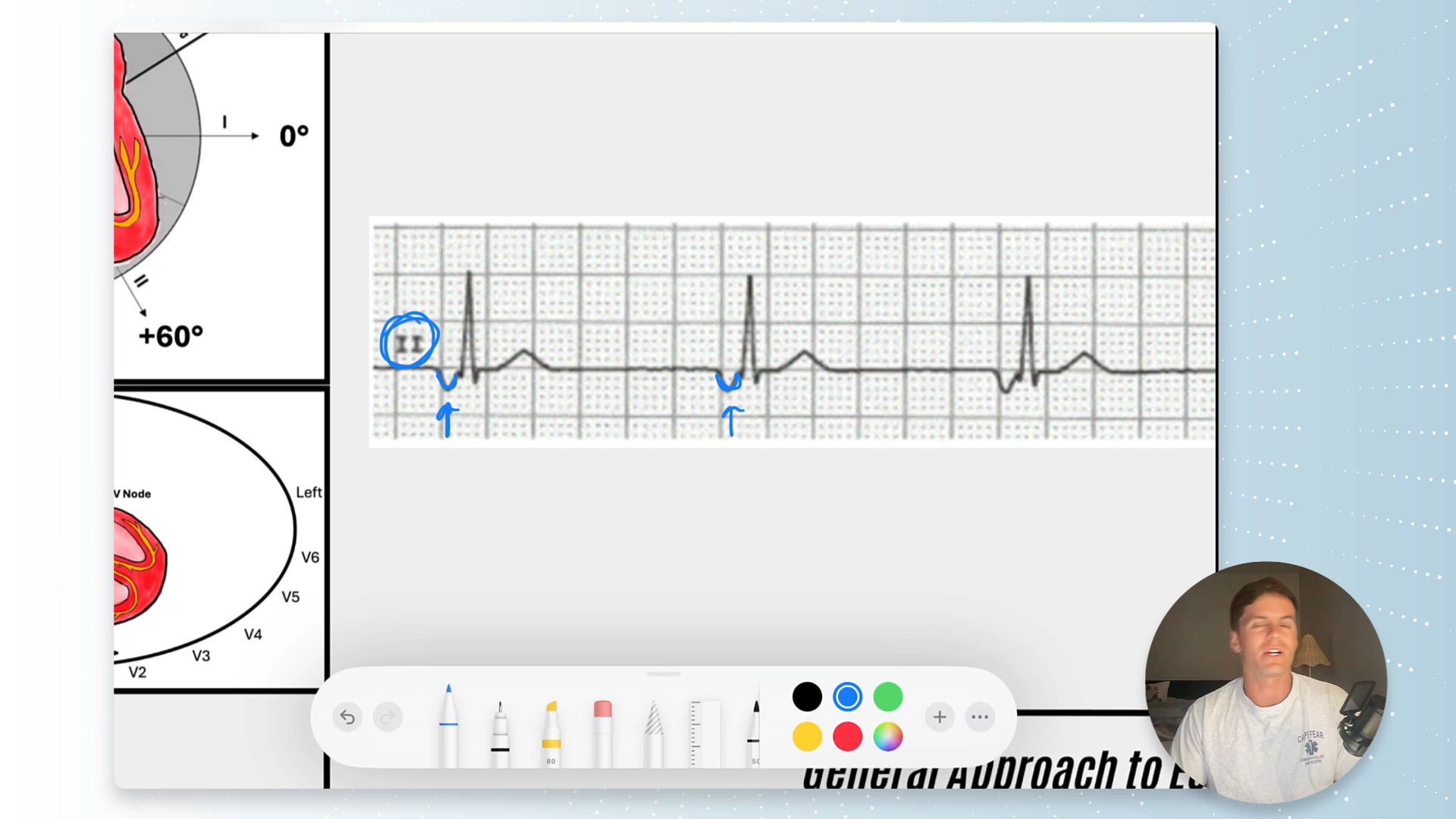 Rhythm=Rhythm  Low Atrial Rhythm vs. Junctional Rhythm: The PR Interval Holds the