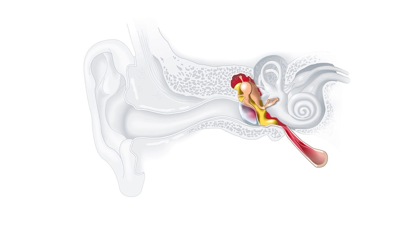 Ear Infections in Children