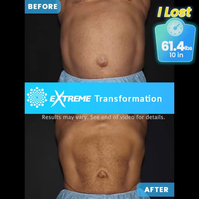 Lipo Orlando, Lipo Florida