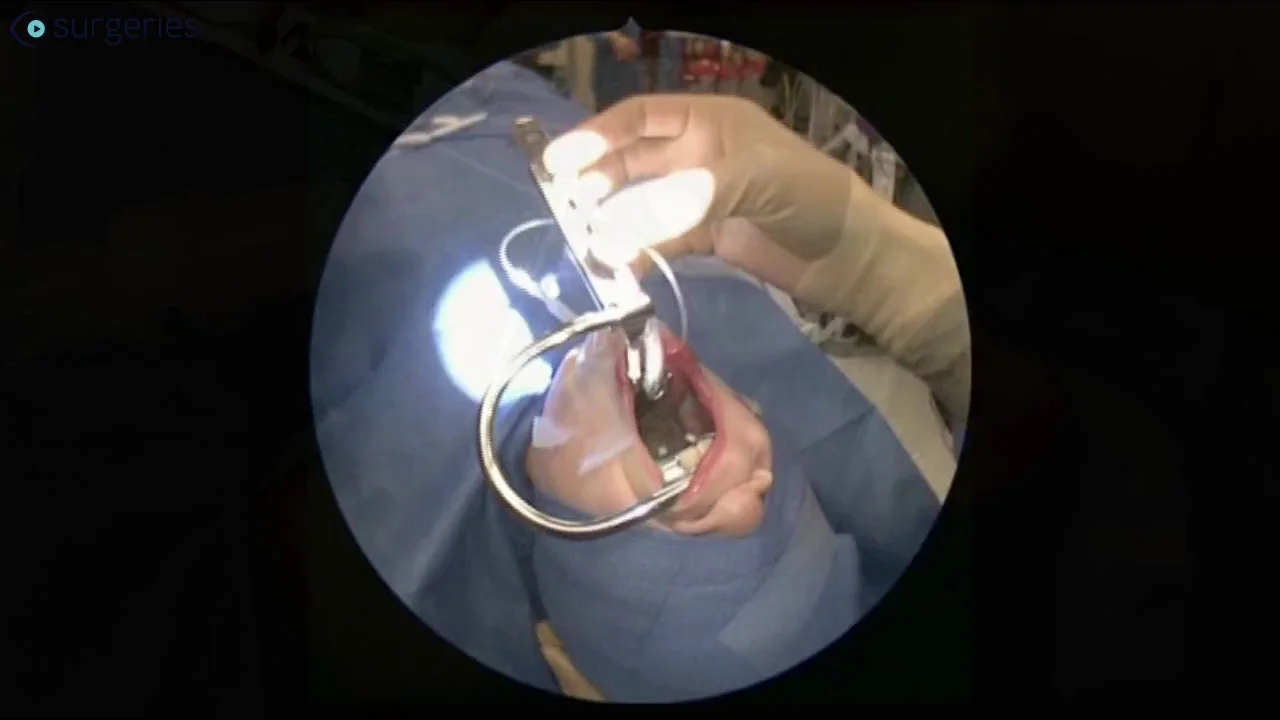 Mouth Gag Tonsillectomy