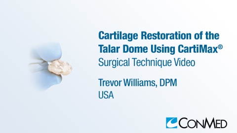 Dr. Williams -  Cartilage Restoration of the Talar Dome Using  CartiMax®