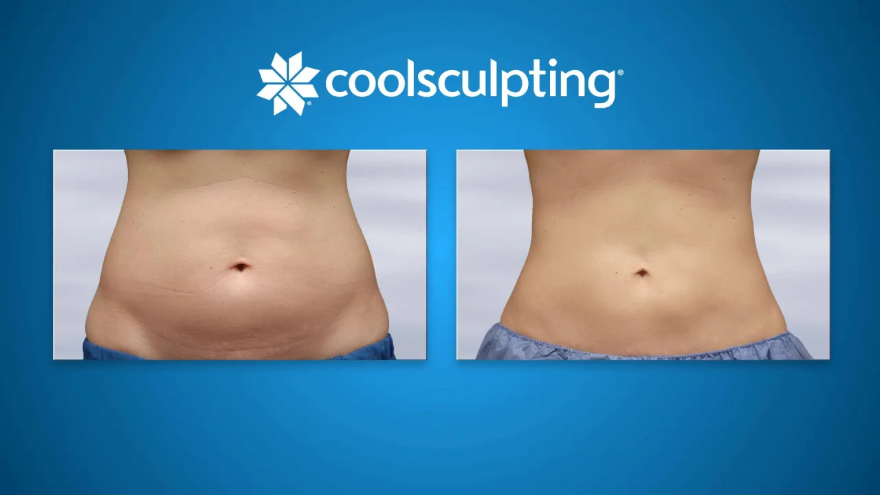 Coolsculpting Before And After