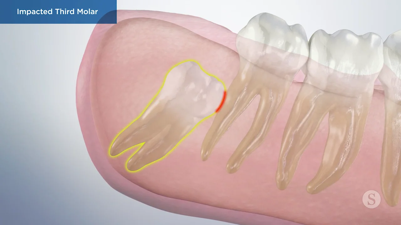 impacted teeth