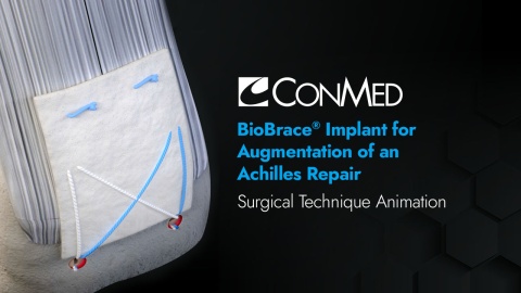 BioBrace® Implant for Augmentation of an Achilles Repair