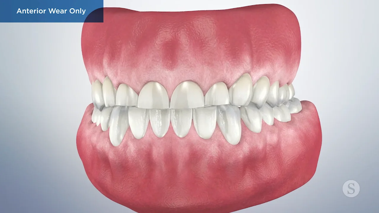 Mouth Guards & Teeth Whitening | Dental TLC