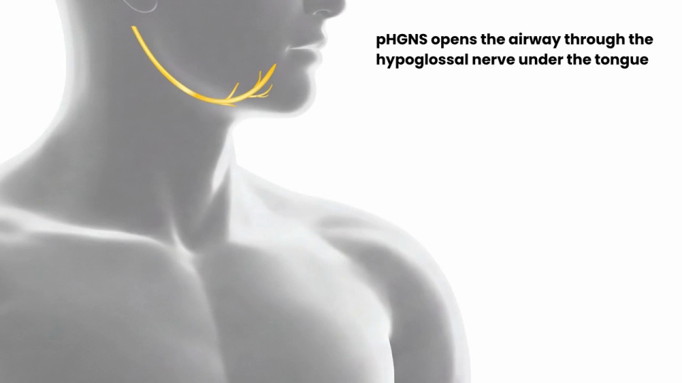 Video: pHGNS components include generator and lead video thumbnail
