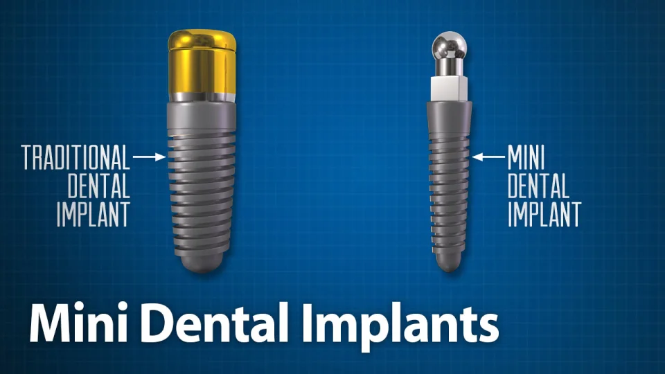 Best Local Affordable Dental Implant Installations  in Jacksonville, Florida thumbnail