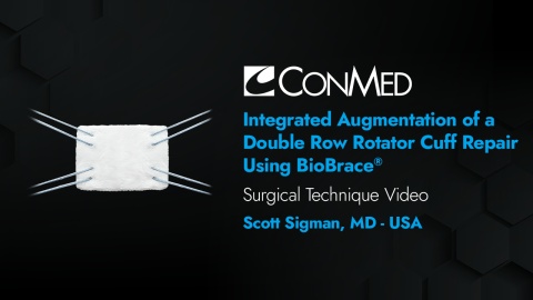 Dr. Sigman - Integrated Augmentation of a Double Row Rotator Cuff Repair using BioBrace®