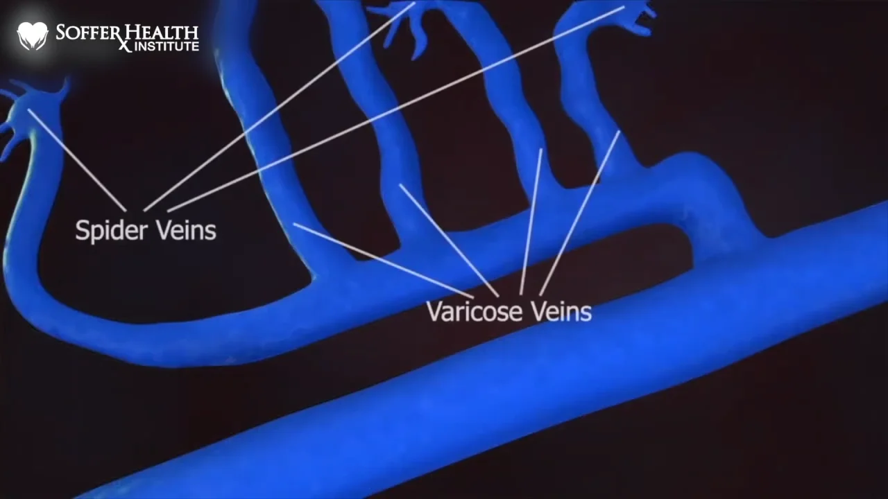 4 Vitamins to Help Fight Spider Veins | Soffer Health Institute Blog