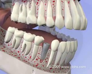 Dental Implant Placement