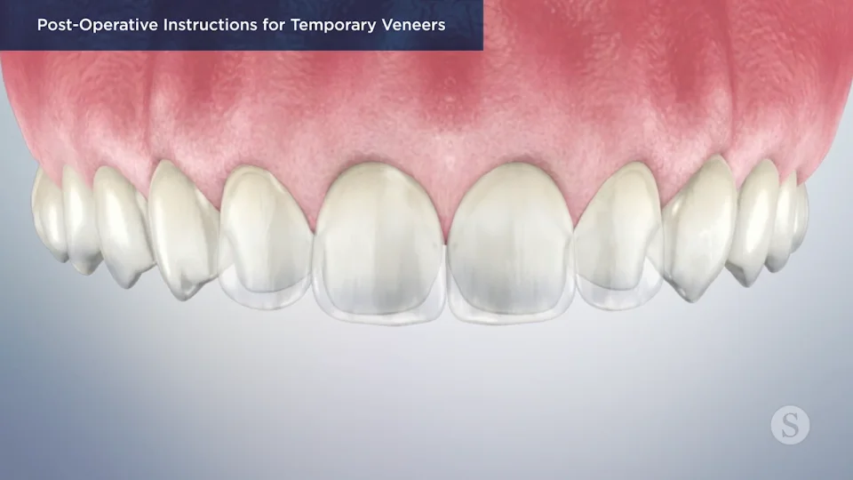 Taking care of temporary dental veneers - Bauer Smiles