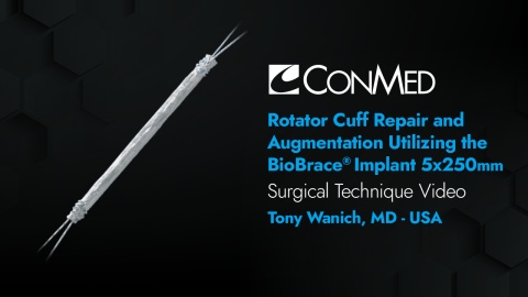 Dr. Wanich - Rotator Cuff Repair and Augmentation Utilizing the BioBrace® Reinforced BioInductive Implant
