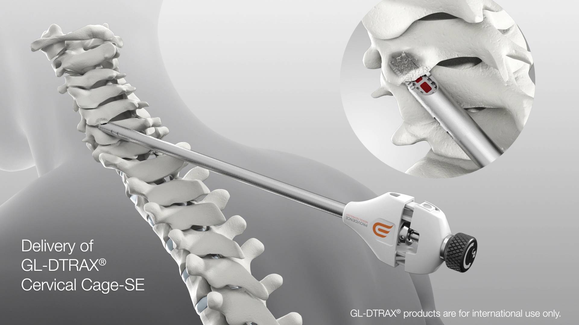 Posterior Cervical Fusion with DTRAX Spinal System | Providence