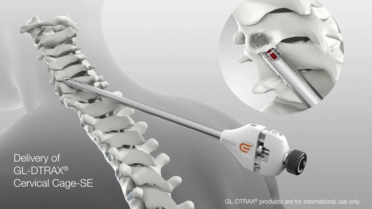 Animation - OUS Posterior Cervical Fusion with DTRAX® Spinal System &  Cage-SE - MKT-PMT-298 Rev 1