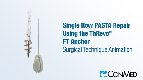 Single Row PASTA Repair Using ThRevo® FT
