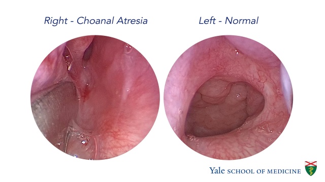 Choanal Atresia What It Is Symptoms Treatment Repair 40 Off 5068