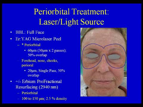 Thumbnail for The Trifecta Combination: Broadband Light, MicroLaserPeel and ProFractional Therapy to Achieve Maximum Results