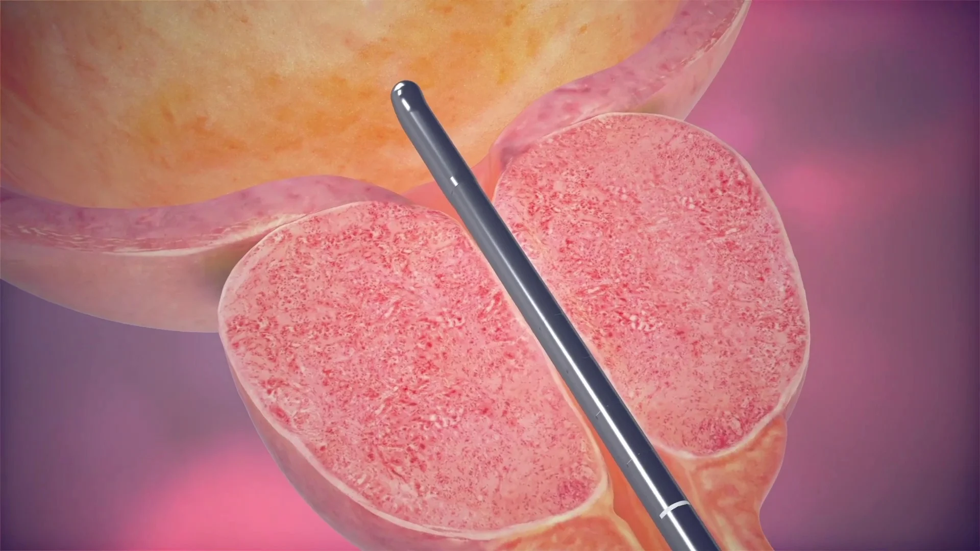 The Urolift System: A Comprehensive Guide For Patients In Denver, CO