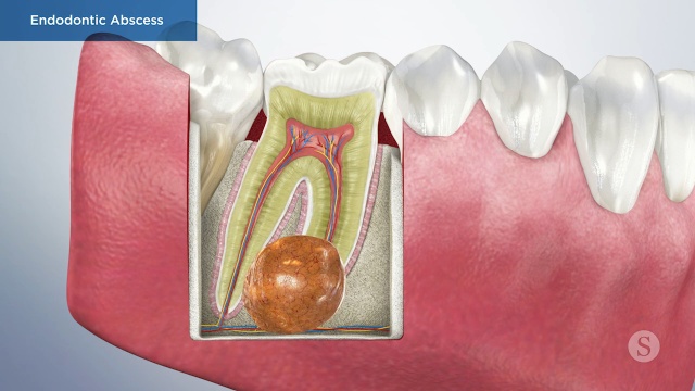 puss bump on gums