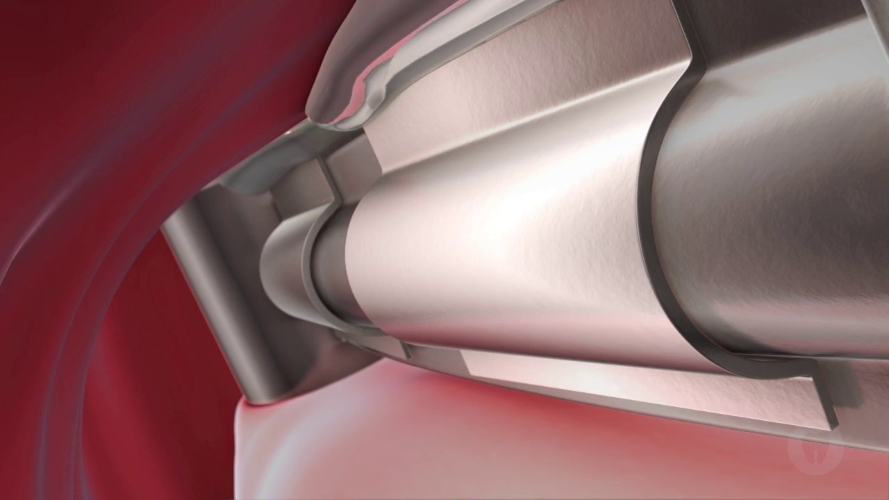 Implant: Four Implants With Denture & Precisio