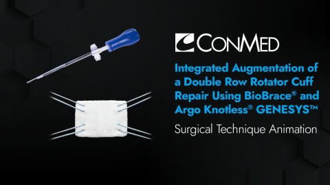 Integrated Augmentation of Double Row Rotator Cuff Repair Using BioBrace® and Argo Knotless® GENESYS™