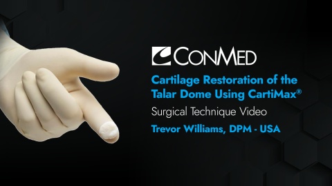 Dr. Williams -  Cartilage Restoration of the Talar Dome Using  CartiMax®