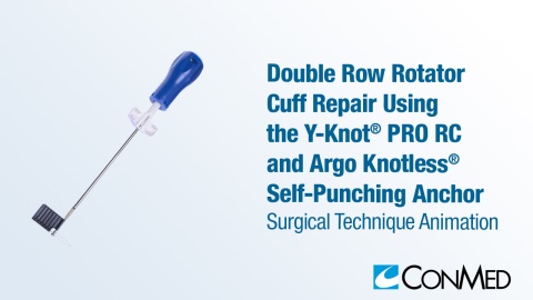 CuffLink™ Double Row Rotator Cuff Repair Using the Y-Knot® PRO RC and Argo Knotless® Self-Punching Anchor
