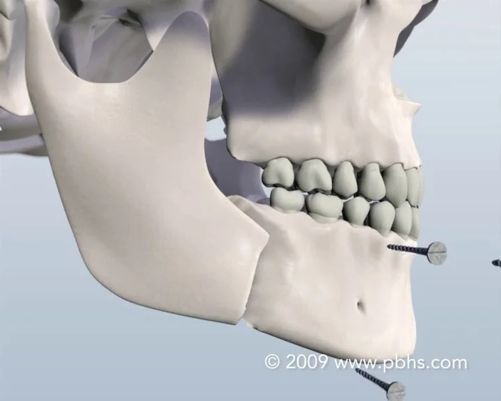 【SURGERY】bone embossing ma-1 SURGERY】bone embossing ma-1 Why I Love “Graphite-Guided” All-On-X