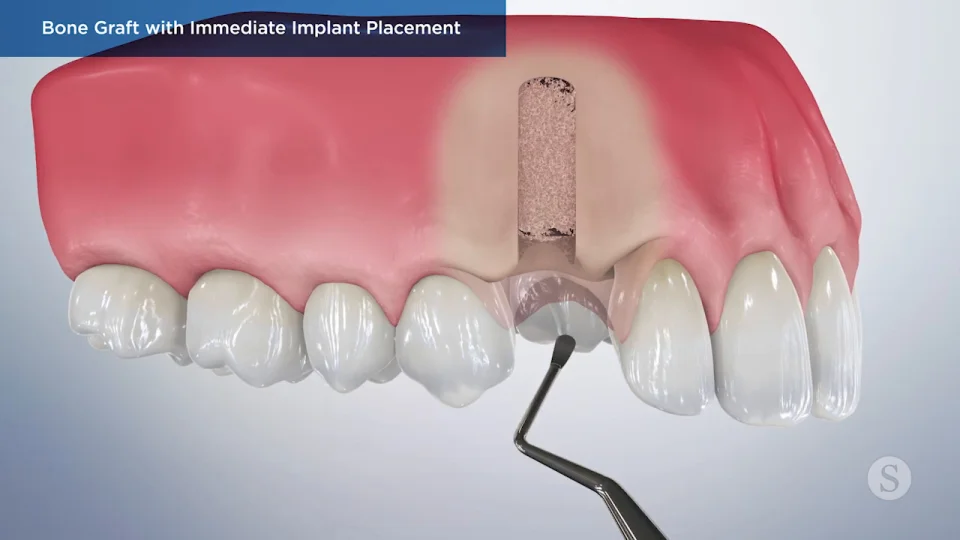 Dental Implant Bone Graft  Bone Grafting for Dental Implant