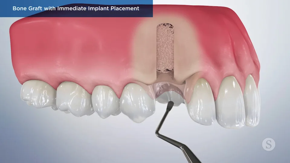 SP007 Bone Graft (Socket Preservation)