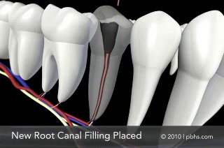 root canal informational video