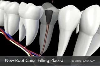 Root Canals in Naperville, IL