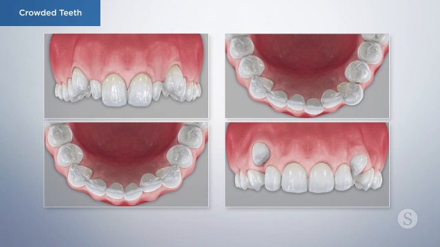 Orthodontics and Braces Ottawa, Dental Clinic
